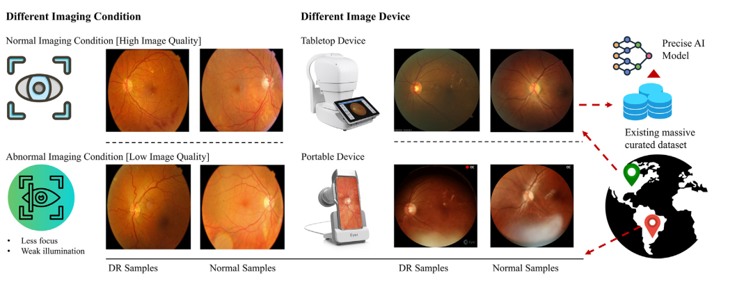 Teaser figure for Enhancing AI-Based Diabetic Retinopathy Screening in Low- and Middle-Income Countries with Synthetic Data